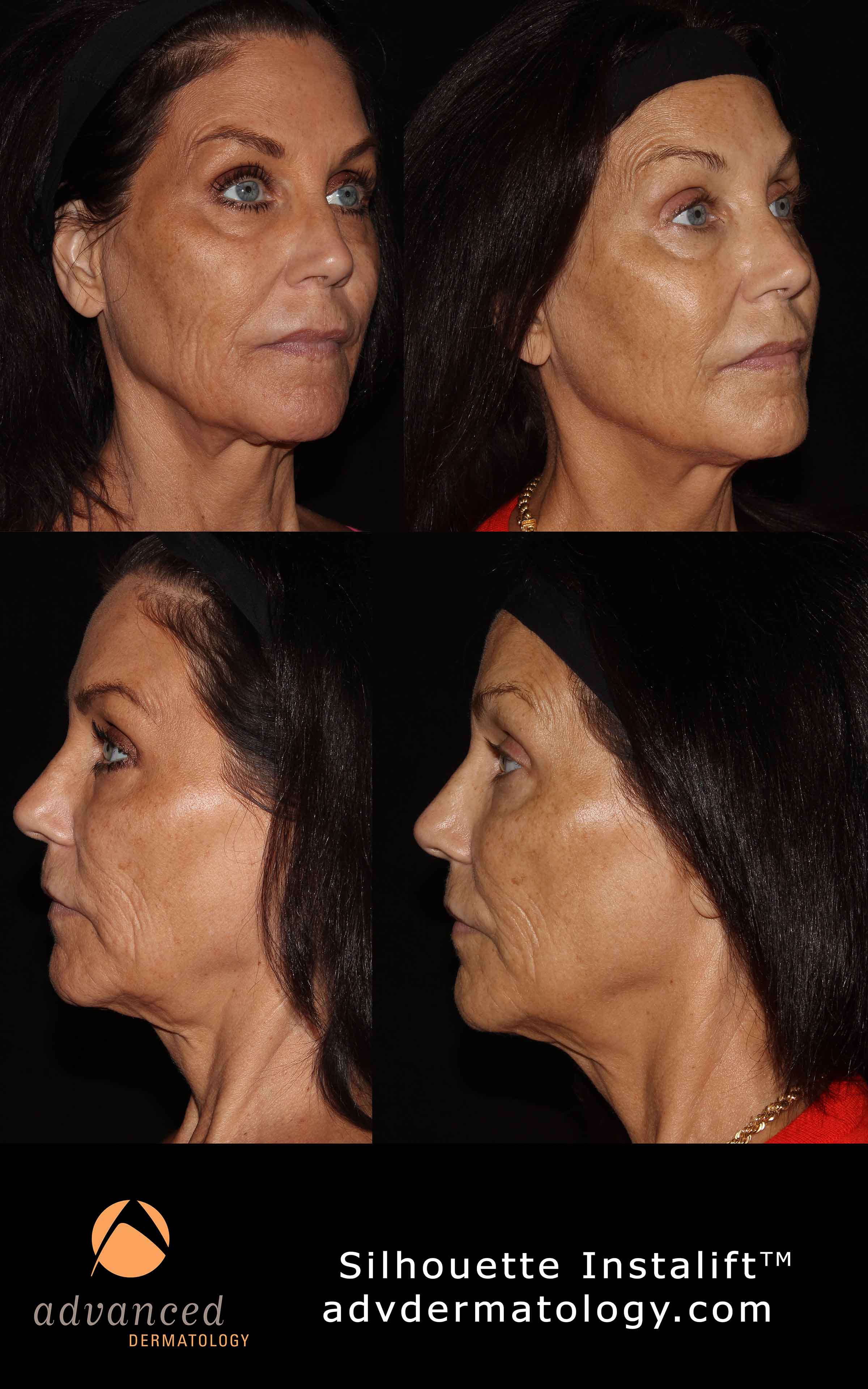 Silhouette Instalift Lifts Deep Layers Of The Skin And Re Contours Face