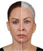 Fillers for Lift in the Face | Advanced Dermatology